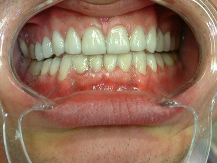 infection sous couronne dentaire mauvaise haleine infection sous couronne dentaire mauvaise haleine